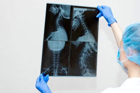 Osteochondrosis Spine Disease