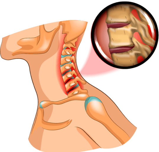 Osteochondral disease on the neck