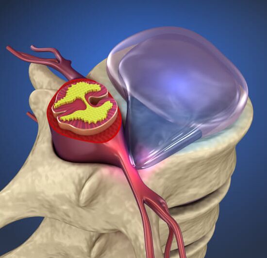 Vertebral hernia