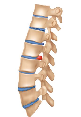 What is dephosphorylated osteocartilage degeneration like