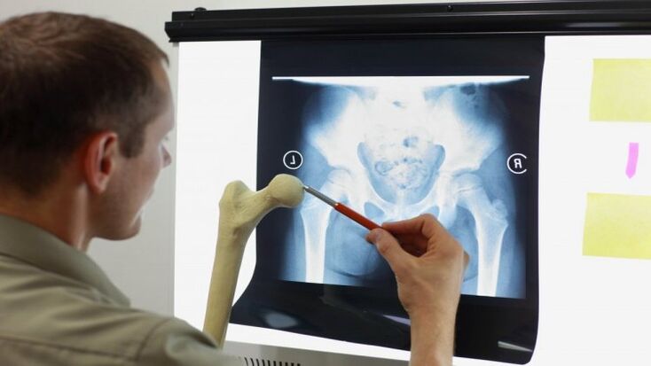 Doctor examining x-ray of hip joint