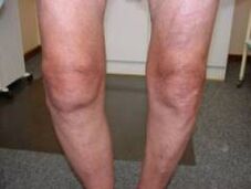 Symptoms of knee arthritis