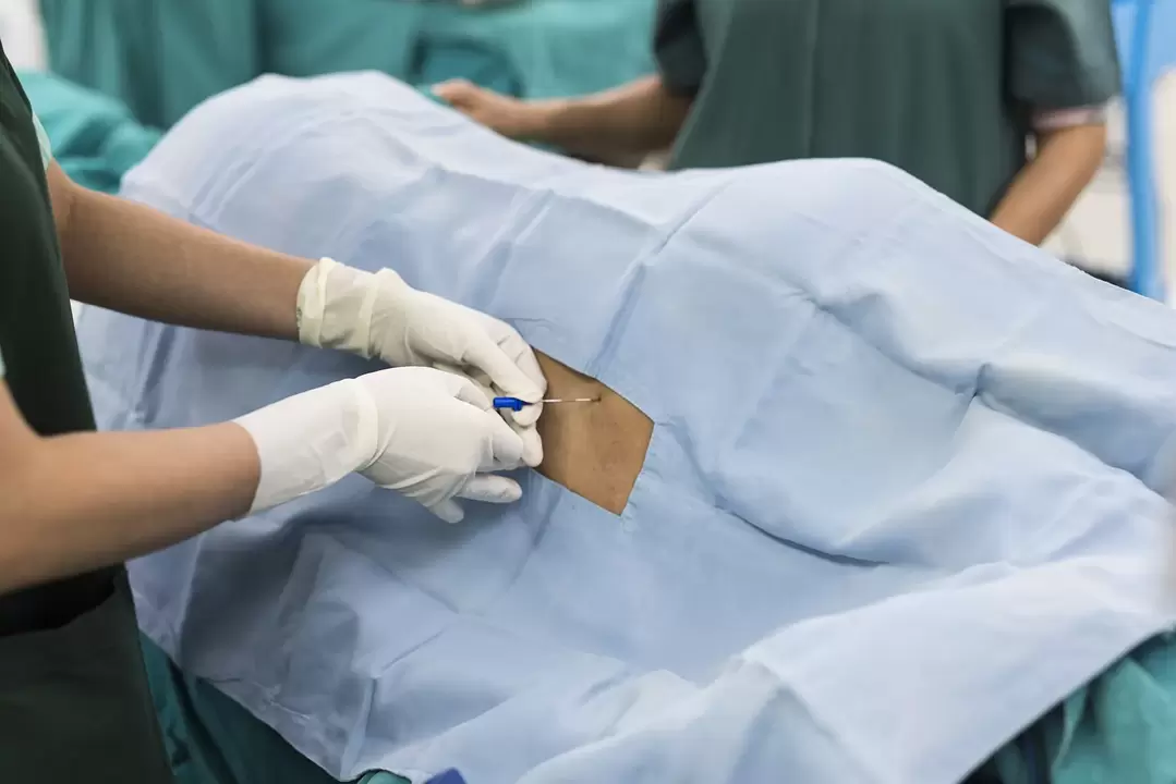 Acupuncture to treat back pain