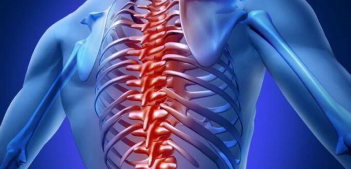 Thoracic osteochondrosis